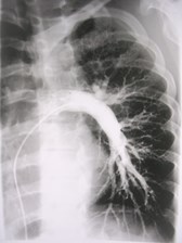 pulm angiogram normal